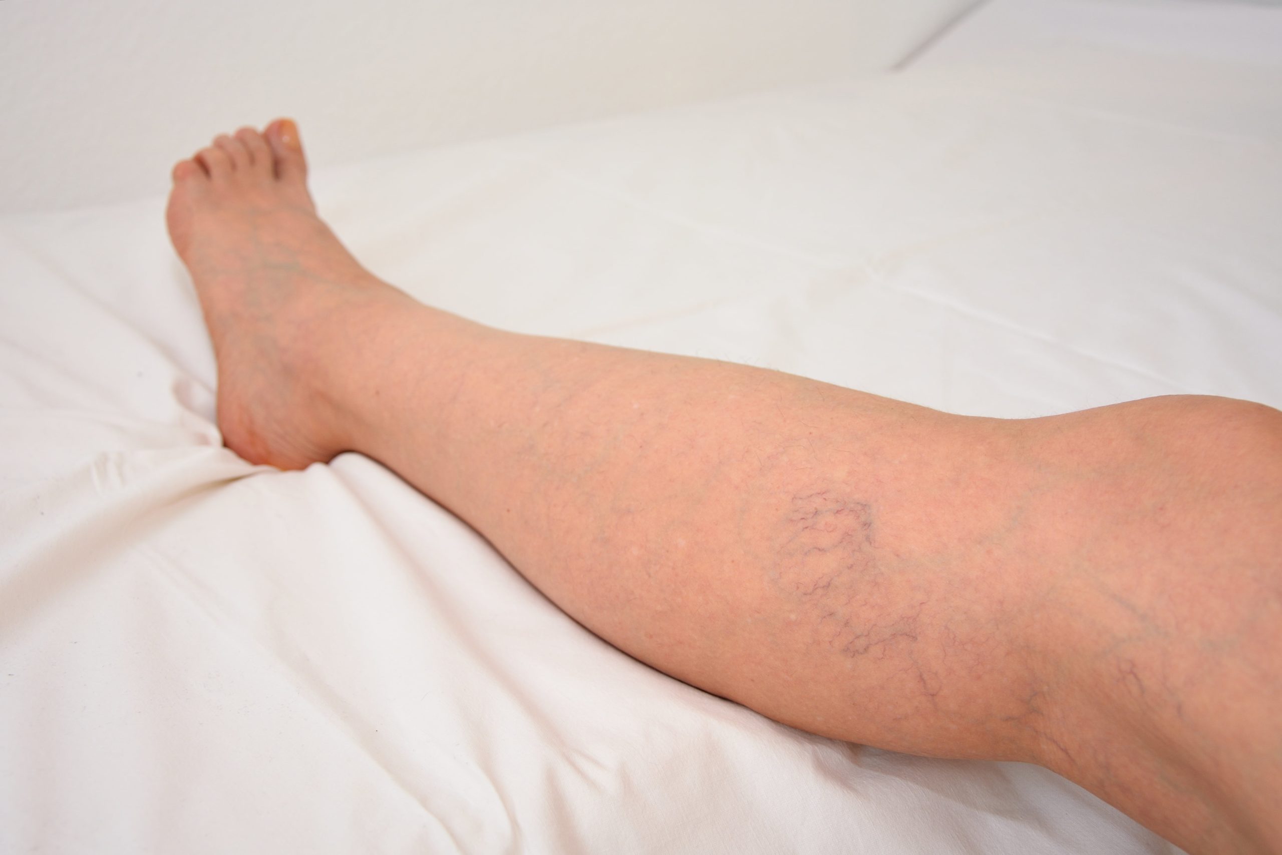 Legs with Spider Veins | Clear Eyes + Aesthetics in Cincinnati, OH